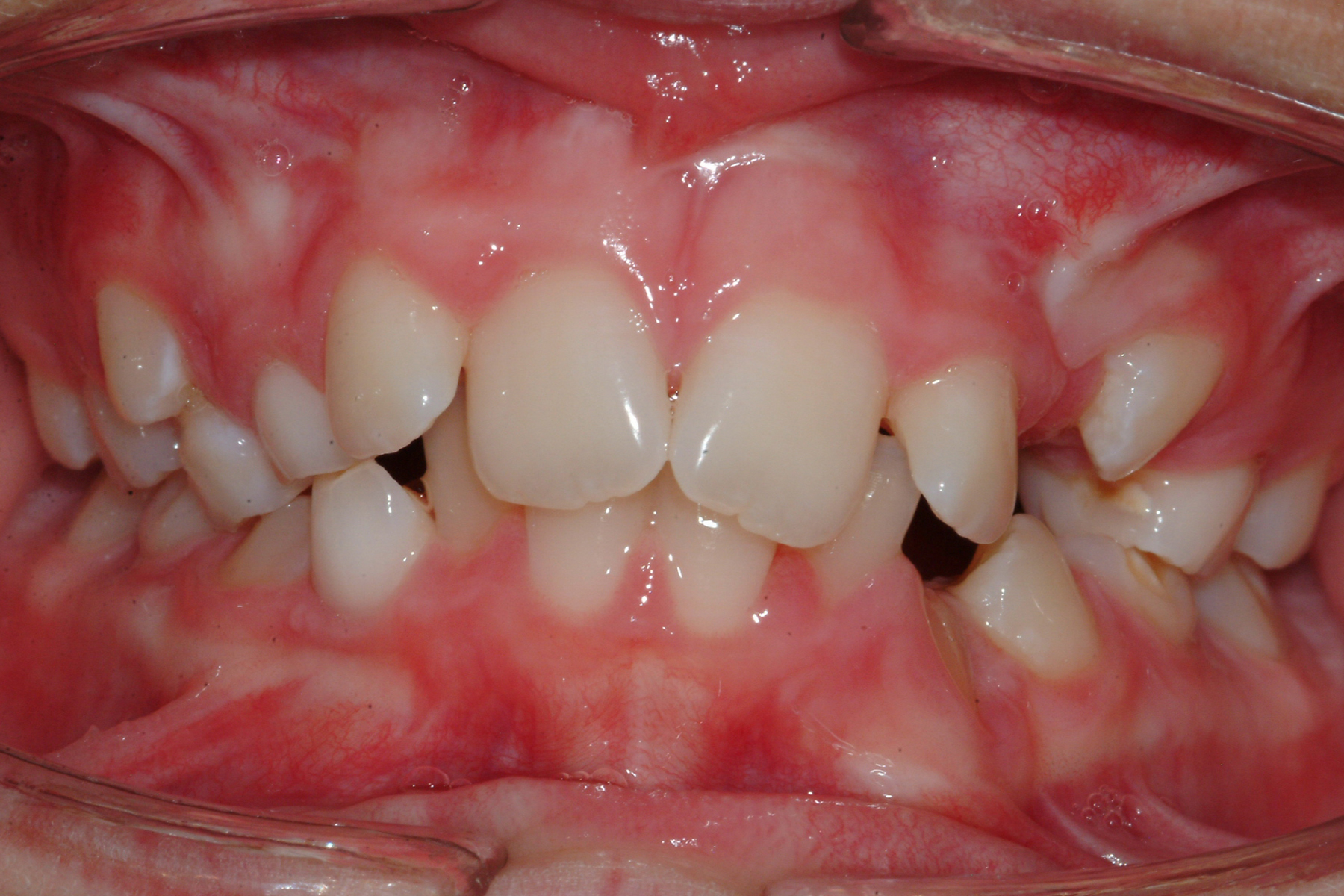 What Does Occlusal Watch Mean at Wesley Doreen blog